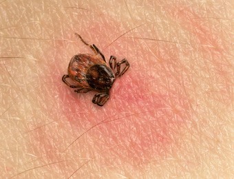 Tick inbedded in skin